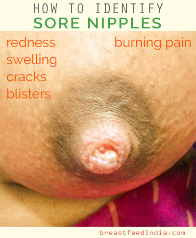 Sore nipples - signs and symptoms